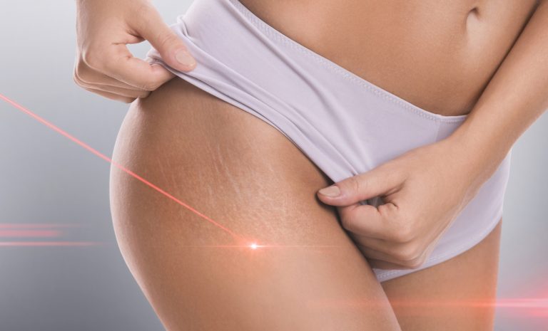 Close-up of female hips with a stretch marks during laser removal session treatment